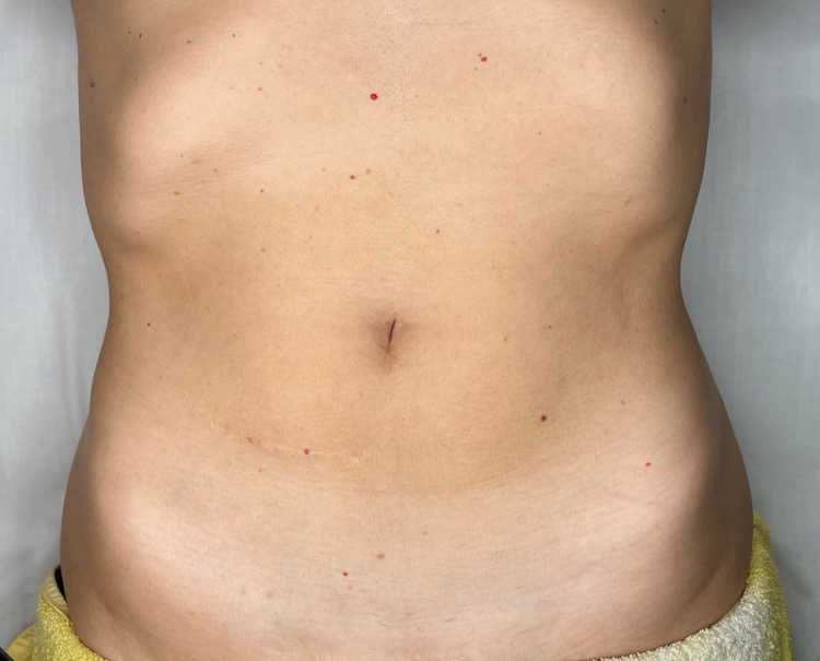 Massagem Modeladora - Antes