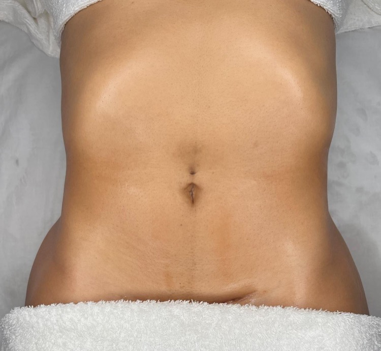 Massagem Modeladora - Resultado 1