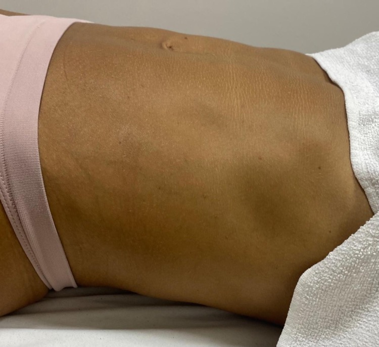 Massagem Modeladora - Resultado 2